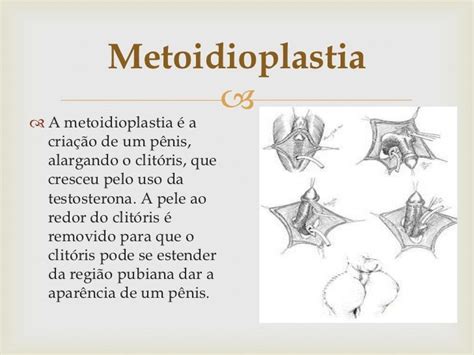 trans a colico|Metoidioplastia: cirurgia de mudança de sexo para homens。